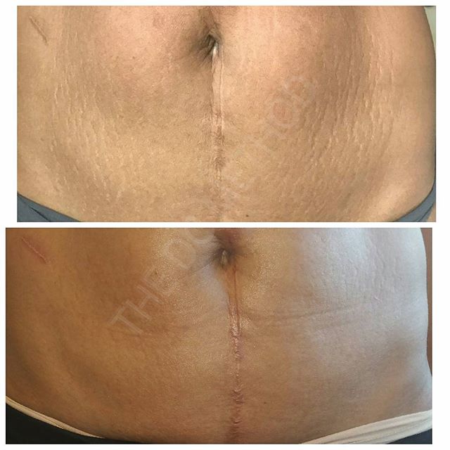 Those who show up get the best results. This is 4 months with more to go! #commitment #stretchmarks #beachbody #bodygoals #ifixscars #permanent #results #bootyfordays #thedcmethod #weightloss #solution #camouflaging #tattoo #scars #skin #celebrities #drs #plasticsurgery #scottsdale #miami #miamibeach #la #drmartyz - Linda Dunn-Carter LE, CPCP (@lindadunncarter)